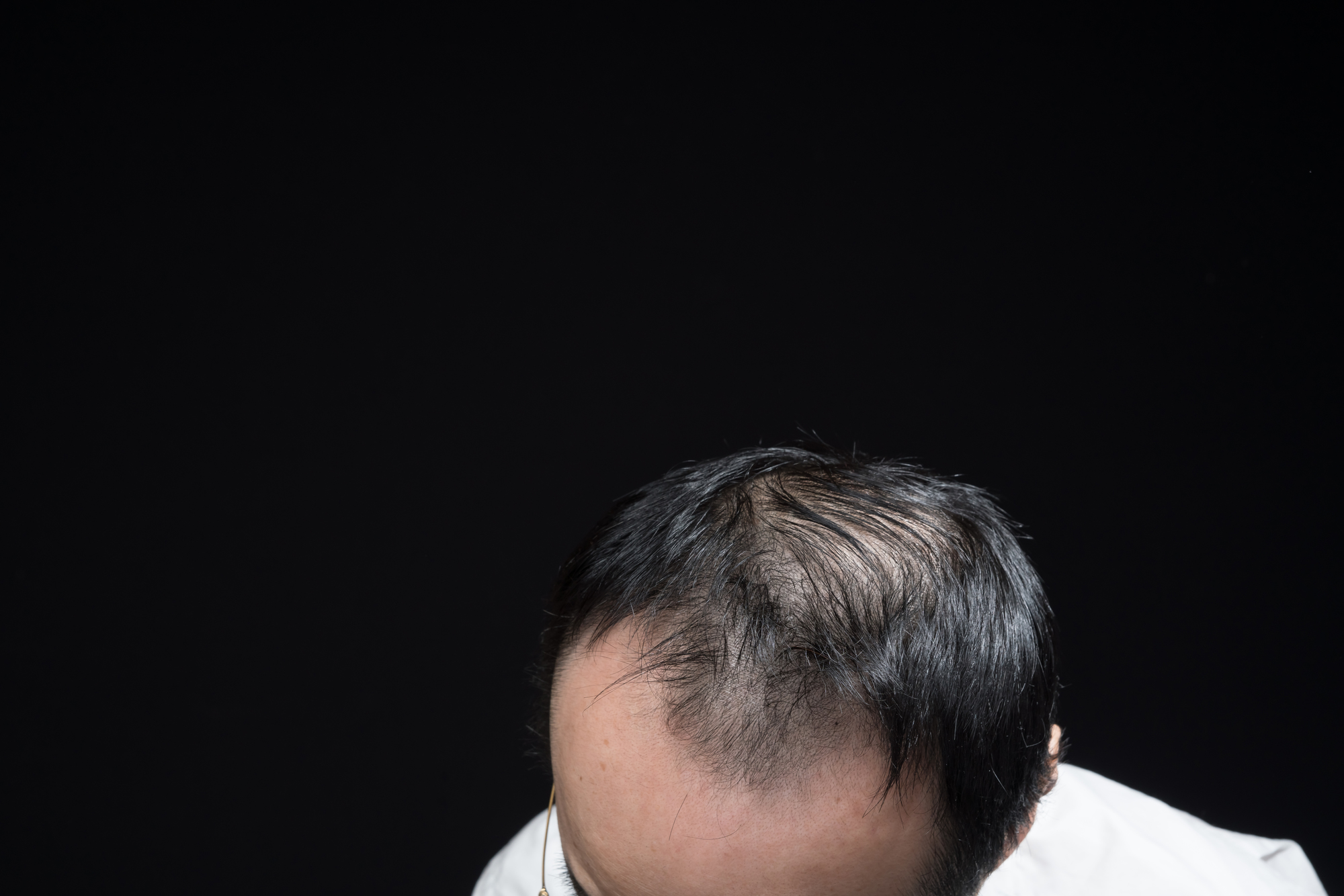 壮年性脱毛症とは？AGAとの違いは？セルフチェック方法と対策解説
